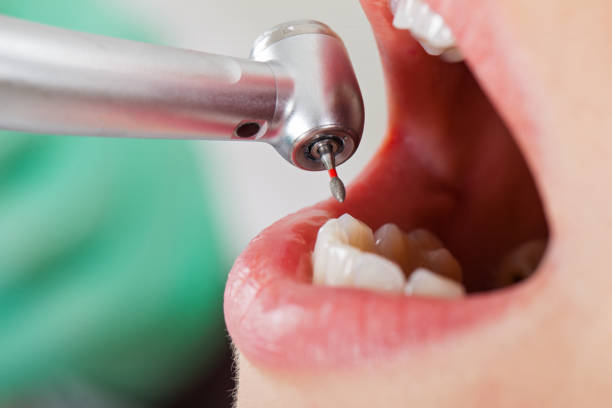 Best Emergency Dentist for Knocked-Out Tooth in Flandreau, SD